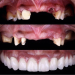 Full mouth rehabilitation