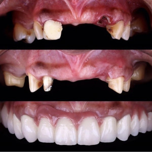 Full mouth rehabilitation