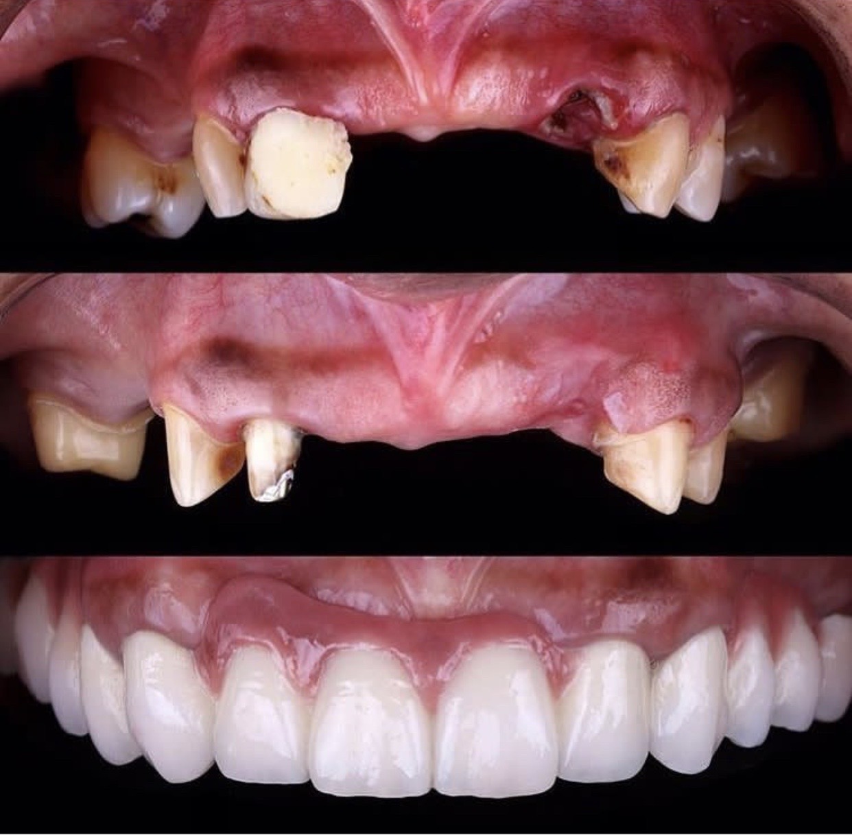 Full mouth rehabilitation
